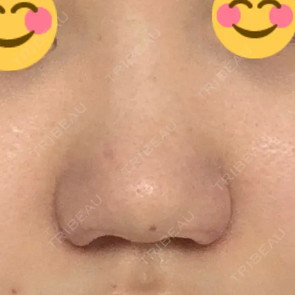 小鼻縮小（切開） / 鼻翼挙上 / 鼻孔縁挙上 くさのたろうクリニック DAY 9 メイン用