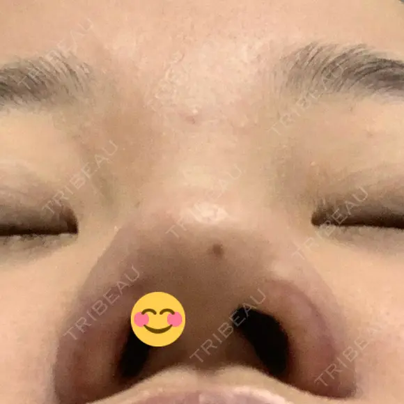 小鼻縮小（切開） / 鼻翼挙上 / 鼻孔縁挙上 くさのたろうクリニック DAY 9 メイン用