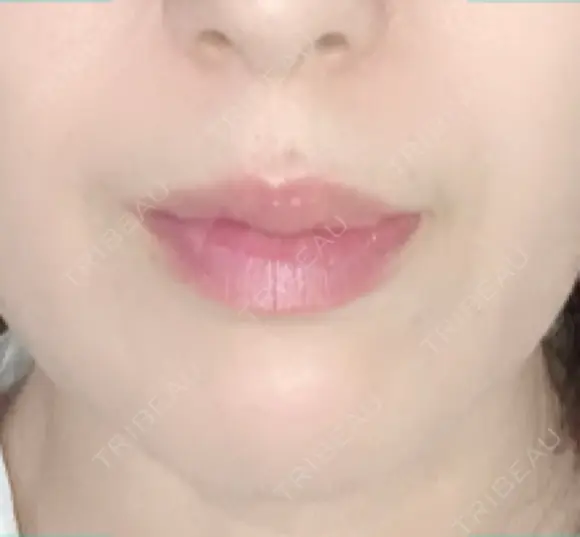 シワ取りボトックス 湘南美容クリニック 藤沢院 AFTER メイン用