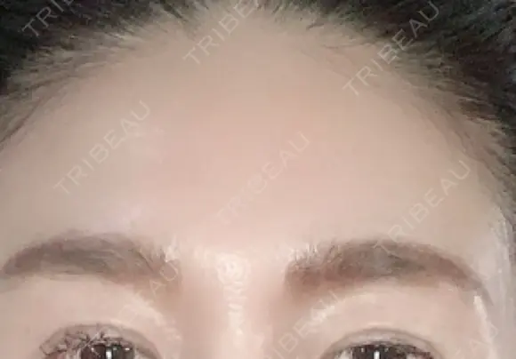 額を丸く / シワ取りボトックス / その他（肌） / その他（輪郭） 湘南美容クリニック 藤沢院 AFTER メイン用