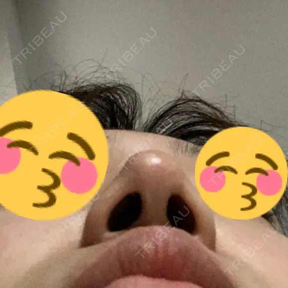 鼻尖形成（切開） / ヒアルロン酸注入（鼻） / ヒアルロン酸注入（あご） 東京ヒルズクリニック 新宿院 DAY 5 メイン用