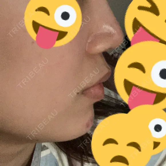 鼻尖形成（切開） / ヒアルロン酸注入（鼻） / ヒアルロン酸注入（あご） 東京ヒルズクリニック 新宿院 DAY 5 メイン用