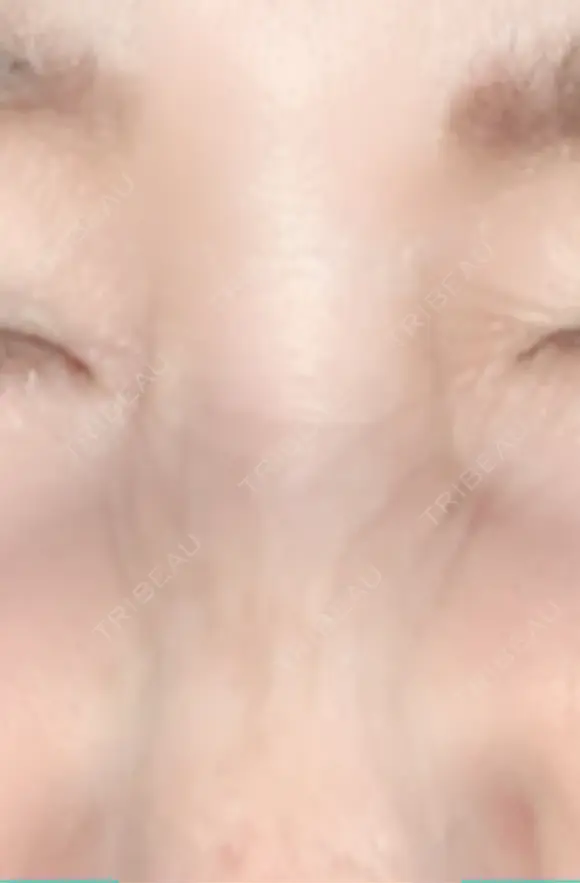 シワ取りボトックス 湘南美容クリニック 藤沢院 AFTER メイン用