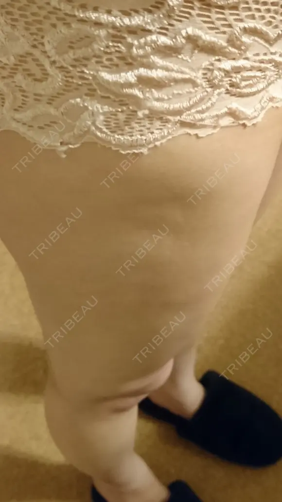 脂肪吸引（脚） ドクターフィット（Dr.fit）クリニック DAY 80 メイン用