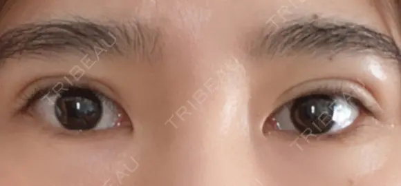 二重切開 松下皮フ形成外科 DAY 24 メイン用