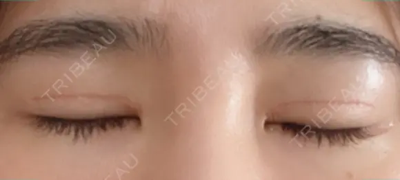 二重切開 松下皮フ形成外科 DAY 24 メイン用