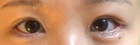 目尻切開 / タレ目形成・グラマラスライン（切開） / 目尻靭帯移動 アネシス美容クリニック DAY 18 メイン用