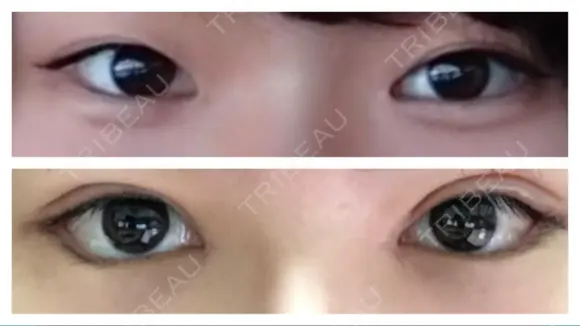 目頭切開 / 眼瞼下垂（切開） / 目尻切開 / 上まぶたの脂肪取り / タレ目形成・グラマラスライン（切開） BIANCA銀座 DAY 13 メイン用