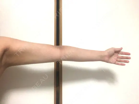 脂肪吸引（二の腕） 銀座マイアミ美容外科 DAY 20 メイン用