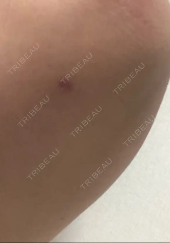 脂肪吸引（二の腕） 銀座マイアミ美容外科 DAY 20 メイン用