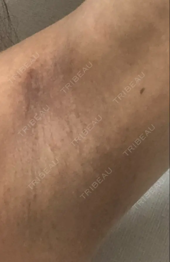 脂肪吸引（二の腕） 銀座マイアミ美容外科 DAY 20 メイン用