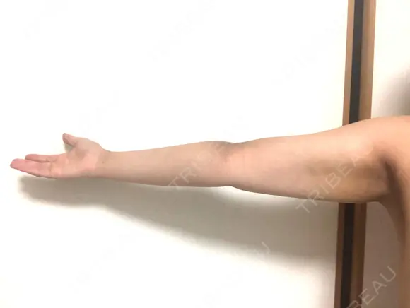 脂肪吸引（二の腕） 銀座マイアミ美容外科 DAY 20 メイン用
