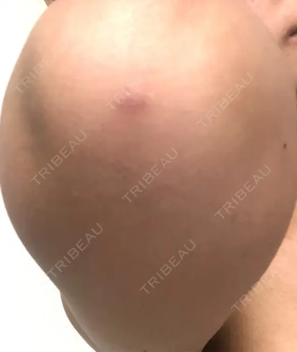 脂肪吸引（二の腕） 銀座マイアミ美容外科 DAY 20 メイン用