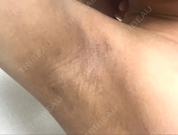 脂肪吸引（二の腕） 銀座マイアミ美容外科 DAY 20 メイン用