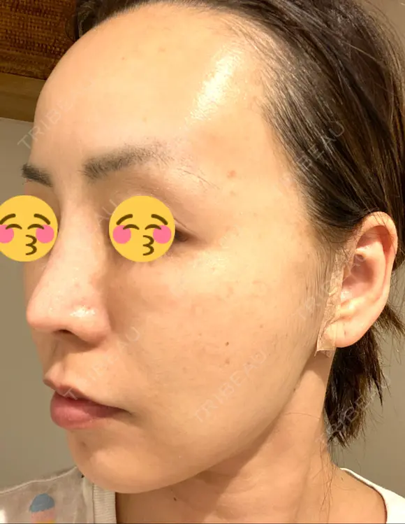 脂肪吸引（顔） / 切開リフト ドクターゴールドマンクリニック 東京高輪院 DAY 43 メイン用