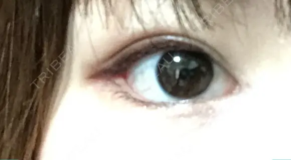 目頭切開 / 眼瞼下垂（切開） / 目尻切開 / 上まぶたの脂肪取り / タレ目形成・グラマラスライン（切開） BIANCA銀座 DAY 15 メイン用