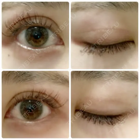 二重切開 / 上まぶたたるみ取り 城本クリニック 姫路院 DAY 84 メイン用