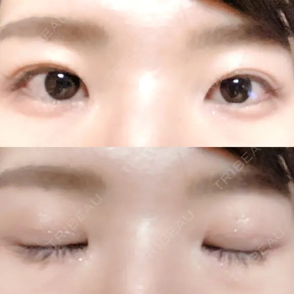 二重切開 松下皮フ形成外科 DAY 49 メイン用