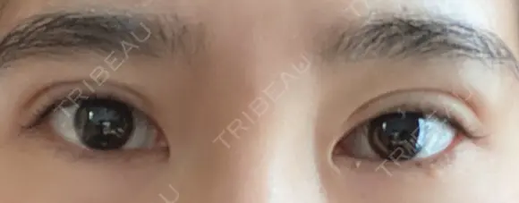 二重切開 松下皮フ形成外科 DAY 29 メイン用