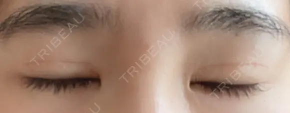 二重切開 松下皮フ形成外科 DAY 29 メイン用