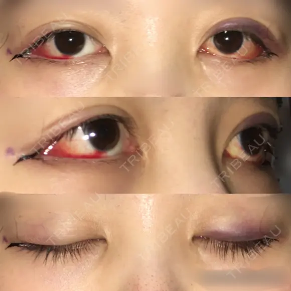目尻切開 / 目尻靭帯移動 FROM B整形外科 (旧バウム整形外科) DAY 1 メイン用