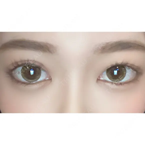 二重切開 / タレ目形成・グラマラスライン（切開） ハナキクリニック AFTER メイン用