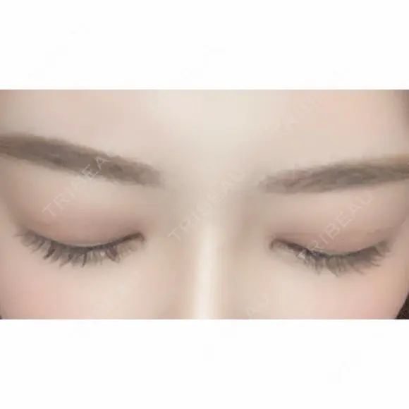 二重切開 / タレ目形成・グラマラスライン（切開） ハナキクリニック DAY 292 メイン用