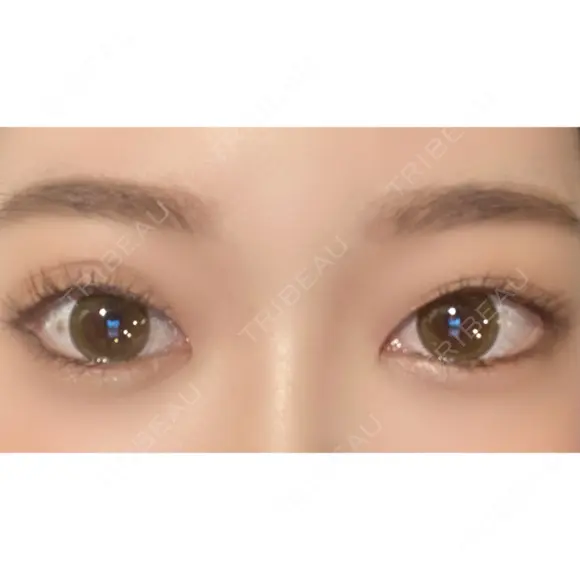 二重切開 / タレ目形成・グラマラスライン（切開） ハナキクリニック DAY 292 メイン用