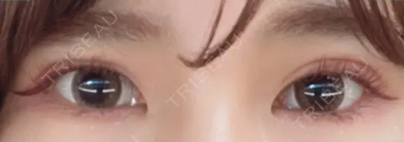 二重切開 松下皮フ形成外科 DAY 31 メイン用