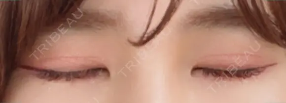 二重切開 松下皮フ形成外科 DAY 31 メイン用