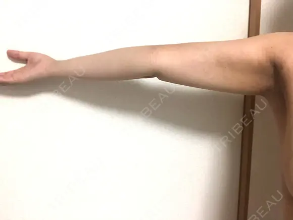 脂肪吸引（二の腕） 銀座マイアミ美容外科 DAY 25 メイン用