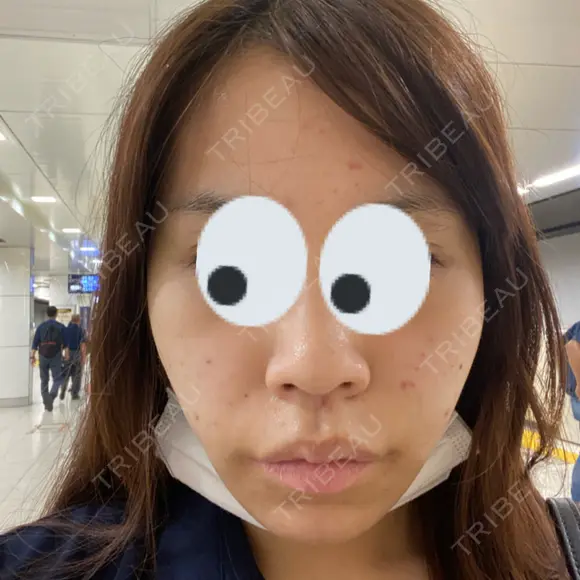 脂肪吸引（顔） ルラ美容クリニック 渋谷本院 DAY 21 メイン用
