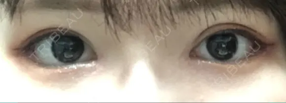 目頭切開 / 眼瞼下垂（切開） / 目尻切開 / 上まぶたの脂肪取り / タレ目形成・グラマラスライン（切開） BIANCA銀座 DAY 19 メイン用