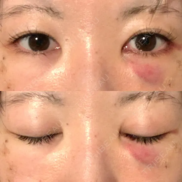 クマ治療 / 下まぶたの脂肪取り 湘南美容クリニック 赤羽院 DAY 1 メイン用