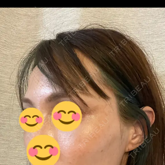 こめかみ形成 SSクリニック DAY 2 メイン用