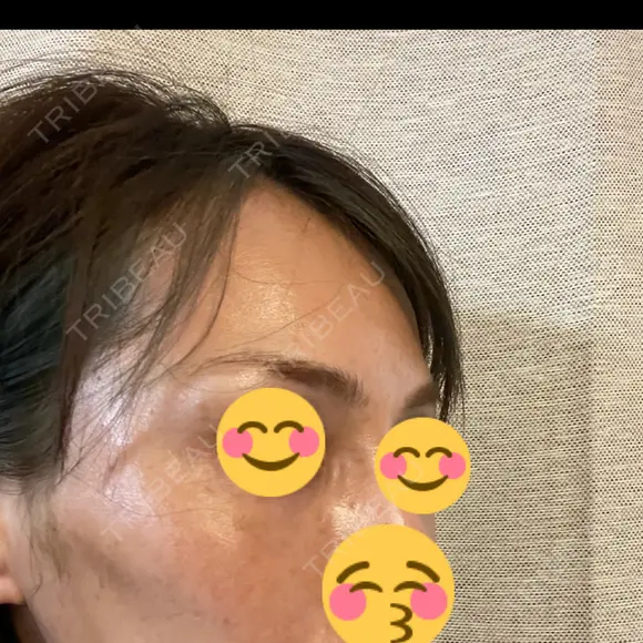 こめかみ形成 SSクリニック DAY 2 メイン用