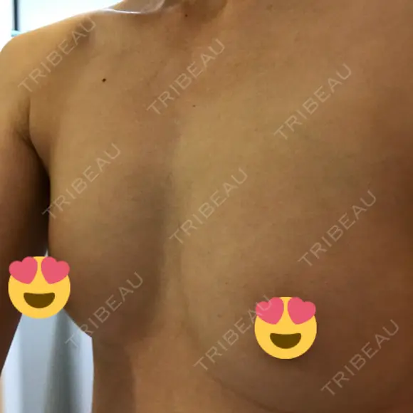 豊胸（脂肪注入） 銀座マイアミ美容外科 DAY 24 メイン用