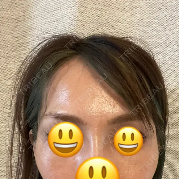 こめかみ形成 SSクリニック DAY 2 メイン用