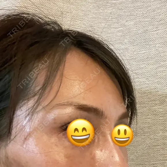 こめかみ形成 SSクリニック DAY 2 メイン用