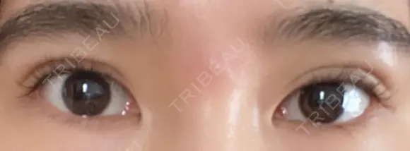 二重切開 松下皮フ形成外科 AFTER メイン用