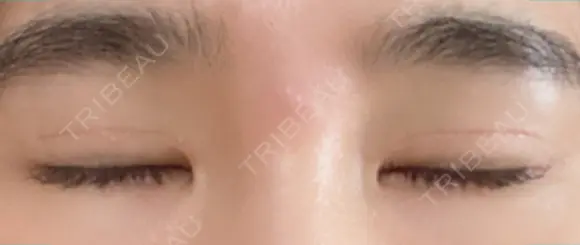 二重切開 松下皮フ形成外科 DAY 34 メイン用