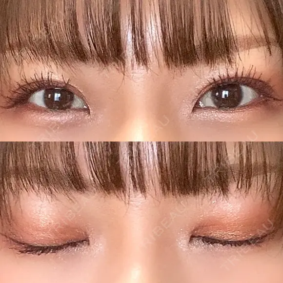 二重埋没 / 自然癒着法 シンデレラ＆ダヴィンチクリニック DAY 91 メイン用