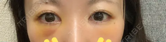 クマ治療 / 下まぶたの脂肪取り 湘南美容クリニック 赤羽院 DAY 3 メイン用