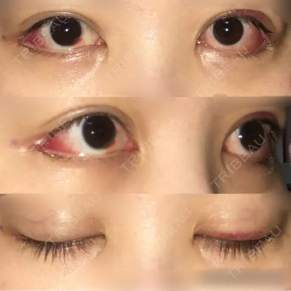 目尻切開 / 目尻靭帯移動 FROM B整形外科 (旧バウム整形外科) DAY 8 メイン用
