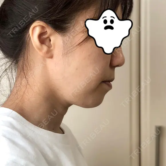 ハイフ（顔） 藤・ナチュレ美容クリニック 恵比寿院 DAY 1 メイン用