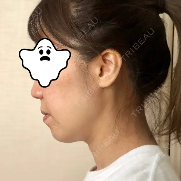 ハイフ（顔） 藤・ナチュレ美容クリニック 恵比寿院 DAY 1 メイン用