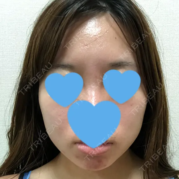 脂肪溶解注射（顔） UB CLINIC銀座 DAY 50 メイン用