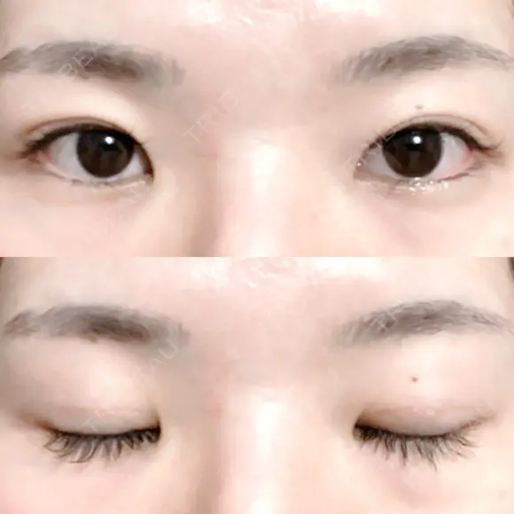 二重切開 松下皮フ形成外科 DAY 58 メイン用