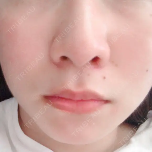 鼻尖形成（切開） / 小鼻縮小（切開） 湘南美容クリニック 神戸院 DAY 80 メイン用