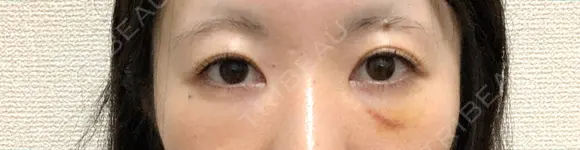 クマ治療 / 下まぶたの脂肪取り 湘南美容クリニック 赤羽院 DAY 7 メイン用
